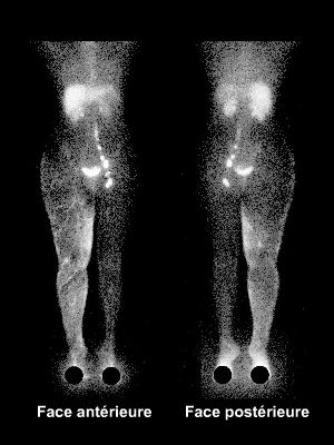 Lymphoscintigraphie des membres inférieurs