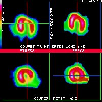 Coupes tomoscintigraphiques
