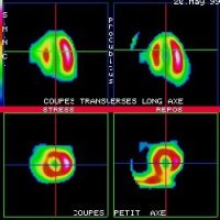 Coupes tomoscintigraphiques