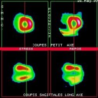 Coupes tomoscintigraphiques