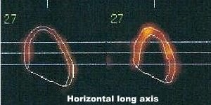 Coupes horizontales long axe en diastole et en systole