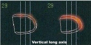 Coupes verticales long axe en diastole et en systole