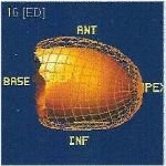 VG 3D - Diastole