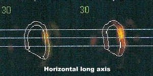 Coupes horizontales long axe en diastole et en systole