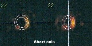 Coupes court axe en diastole et en systole