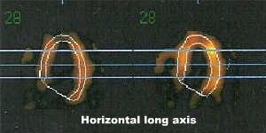 Coupes horizontales long axe en diastole et en systole