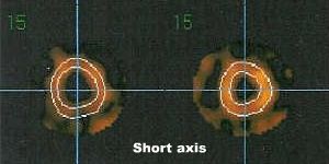 Coupes court axe en diastole et en systole