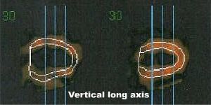 Coupes verticales long axe en diastole et en systole