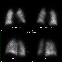 Perfusion