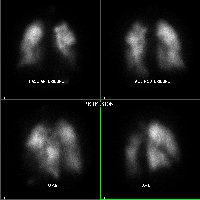 Perfusion