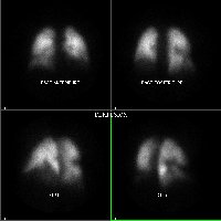 Perfusion