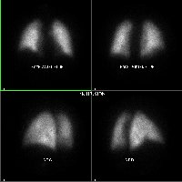 Perfusion