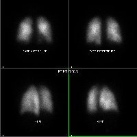 Perfusion