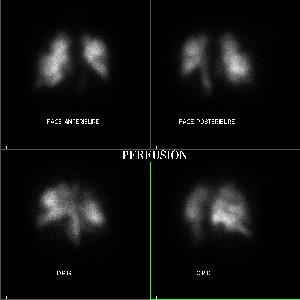 Perfusion