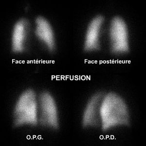 Perfusion