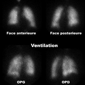 Ventilation pulmonaire