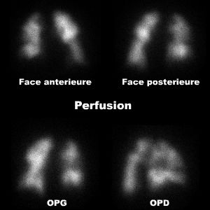 Perfusion pulmonaire