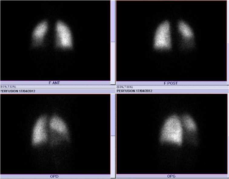 Scintigraphie pulmonaire de perfusion