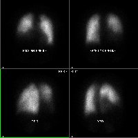 Perfusion