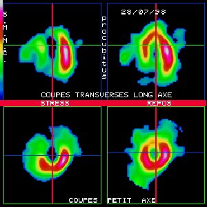 Scintigraphie myocardique au Thallium