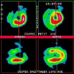 Scintigraphie myocardique au Thallium