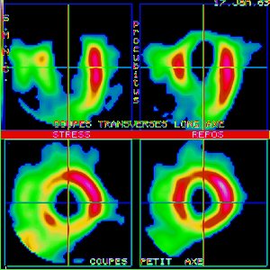 Tomoscintigraphie myocardique au Thallium