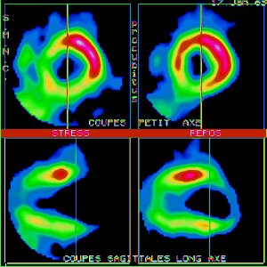 Tomoscintigraphie myocardique au Thallium