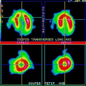 Tomoscintigraphie myocardique au Thallium