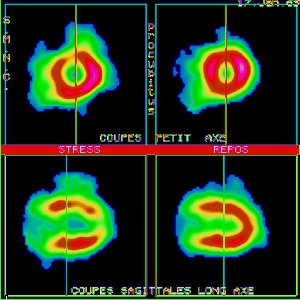 Tomoscintigraphie myocardique au Thallium