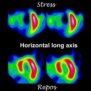 Coupes horizontales long axe