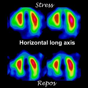 Coupes horizontales long axe