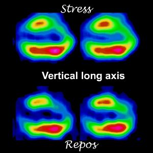 Coupes verticales long axe