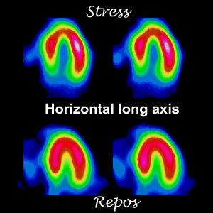 Coupes horizontales long axe