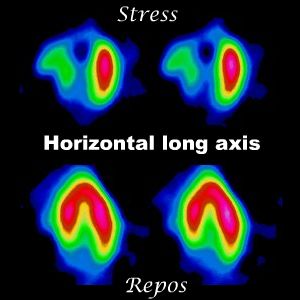 Coupes horizontales long axe