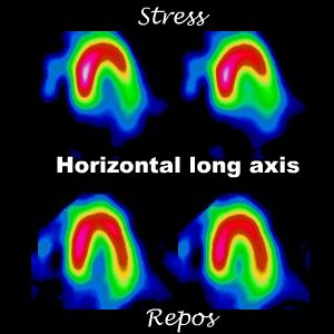 Coupes horizontales long axe