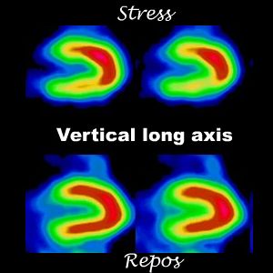 Coupes verticales long axe