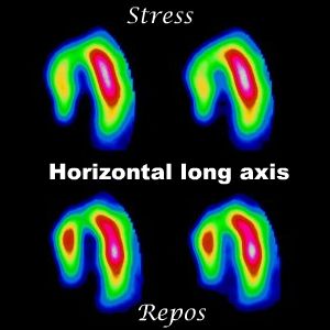 Coupes horizontales long axe