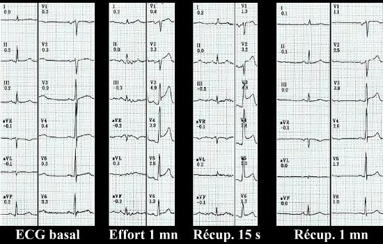 ECG