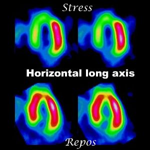 Coupes horizontales long axe