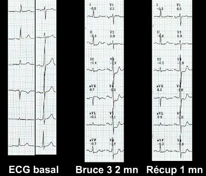 ECG