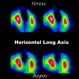 Coupes horizontales long axe