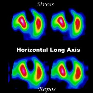 Coupes horizontales long axe