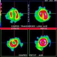 Coupes tomoscintigraphiques