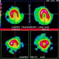 Coupes tomoscintigraphiques