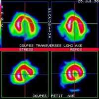 Coupes tomoscintigraphiques