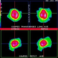 Coupes tomoscintigraphiques