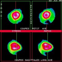 Coupes tomoscintigraphiques