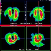 Coupes tomoscintigraphiques