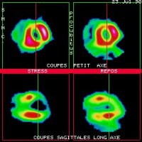 Coupes tomoscintigraphiques