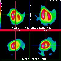 Coupes tomoscintigraphiques